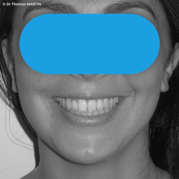 Chirurgie Bimaxillaire : Correction d'un sourire gingival